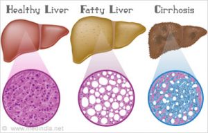 fatty liver