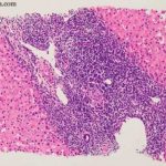 Histopathology_images_of_Primary_biliary_cirrhosis__PBC__by_PathPedia_com__Pathology_e-Atlas-450x338