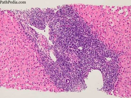 Histopathology_images_of_Primary_biliary_cirrhosis__PBC__by_PathPedia_com__Pathology_e-Atlas-450x338