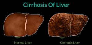 cirrhosis image