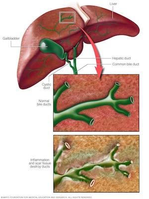 primary biliary cholangitis